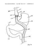 GASTROINTESTINAL BYPASS SLEEVE AS AN ADJUNCT TO BARIATRIC SURGERY diagram and image