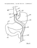 GASTROINTESTINAL BYPASS SLEEVE AS AN ADJUNCT TO BARIATRIC SURGERY diagram and image