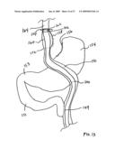 GASTROINTESTINAL BYPASS SLEEVE AS AN ADJUNCT TO BARIATRIC SURGERY diagram and image