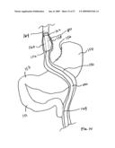 GASTROINTESTINAL BYPASS SLEEVE AS AN ADJUNCT TO BARIATRIC SURGERY diagram and image