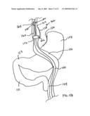 GASTROINTESTINAL BYPASS SLEEVE AS AN ADJUNCT TO BARIATRIC SURGERY diagram and image