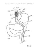 GASTROINTESTINAL BYPASS SLEEVE AS AN ADJUNCT TO BARIATRIC SURGERY diagram and image