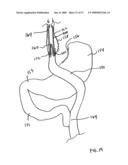 GASTROINTESTINAL BYPASS SLEEVE AS AN ADJUNCT TO BARIATRIC SURGERY diagram and image