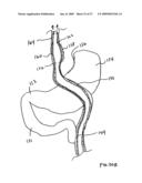 GASTROINTESTINAL BYPASS SLEEVE AS AN ADJUNCT TO BARIATRIC SURGERY diagram and image