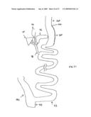 GASTROINTESTINAL BYPASS SLEEVE AS AN ADJUNCT TO BARIATRIC SURGERY diagram and image