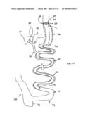 GASTROINTESTINAL BYPASS SLEEVE AS AN ADJUNCT TO BARIATRIC SURGERY diagram and image