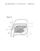 Method And Device For The Treatment Of Obstructive Sleep Apnea And Snoring diagram and image