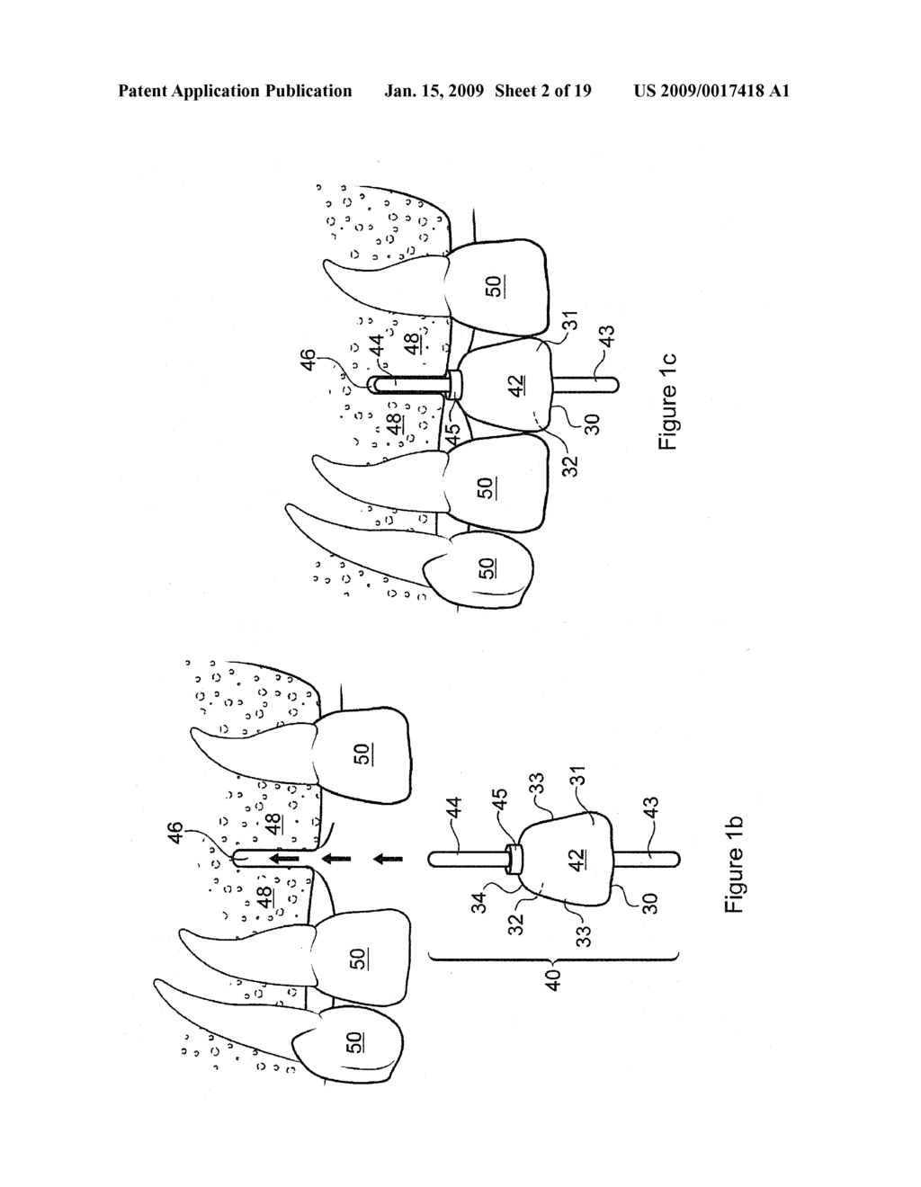 DENTAL IMPLANT SURGICAL GUIDE - diagram, schematic, and image 03