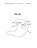 METHODS AND DEVICES FOR PLACEMENT OF AN INTRA-ABDOMINAL OR INTRA-THORACIC APPLIANCE THROUGH A NATURAL BODY ORIFICE diagram and image