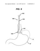 METHODS AND DEVICES FOR PLACEMENT OF AN INTRA-ABDOMINAL OR INTRA-THORACIC APPLIANCE THROUGH A NATURAL BODY ORIFICE diagram and image