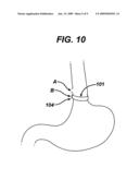 METHODS AND DEVICES FOR PLACEMENT OF AN INTRA-ABDOMINAL OR INTRA-THORACIC APPLIANCE THROUGH A NATURAL BODY ORIFICE diagram and image