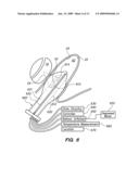 TRANSRECTAL ULTRASOUND ABLATION PROBE diagram and image