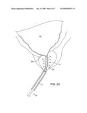 MINIMALLY INVASIVE METHODS AND DEVICES FOR THE TREATMENT OF PROSTATE DISEASES diagram and image