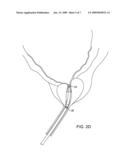 MINIMALLY INVASIVE METHODS AND DEVICES FOR THE TREATMENT OF PROSTATE DISEASES diagram and image