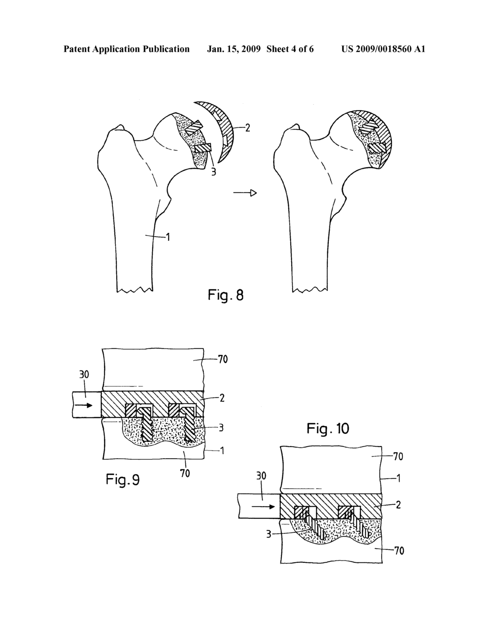 METHOD FOR FASTENING AN IMPLANT TO BONE TISSUE AND CORRESPONDING IMPLANT SYSTEM - diagram, schematic, and image 05