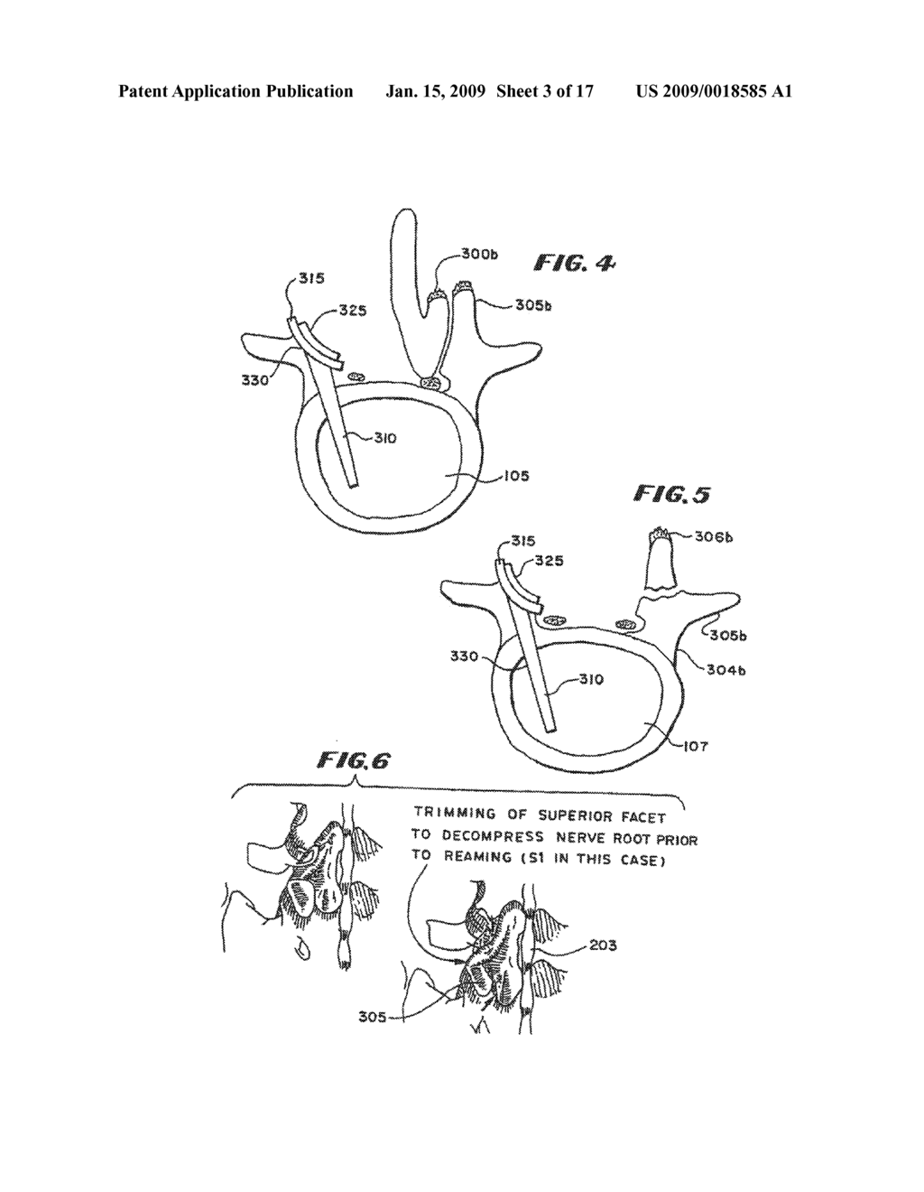 FACET ARTHROPLASTY DEVICES AND METHODS - diagram, schematic, and image 04
