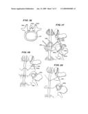 FACET ARTHROPLASTY DEVICES AND METHODS diagram and image