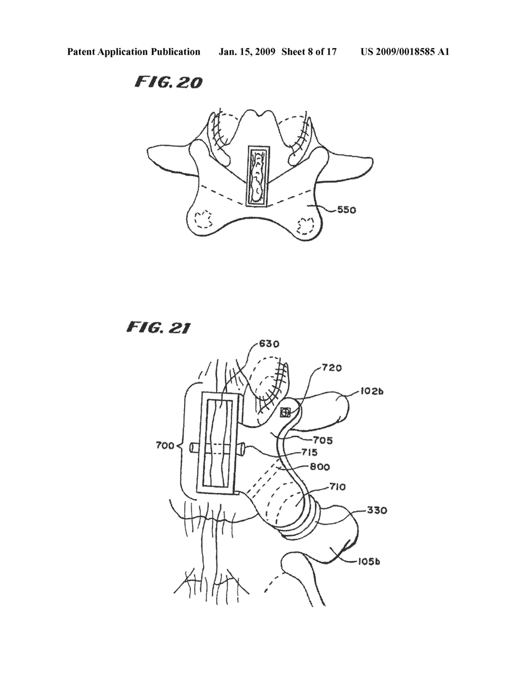 FACET ARTHROPLASTY DEVICES AND METHODS - diagram, schematic, and image 09