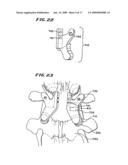 FACET ARTHROPLASTY DEVICES AND METHODS diagram and image