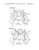 FACET ARTHROPLASTY DEVICES AND METHODS diagram and image