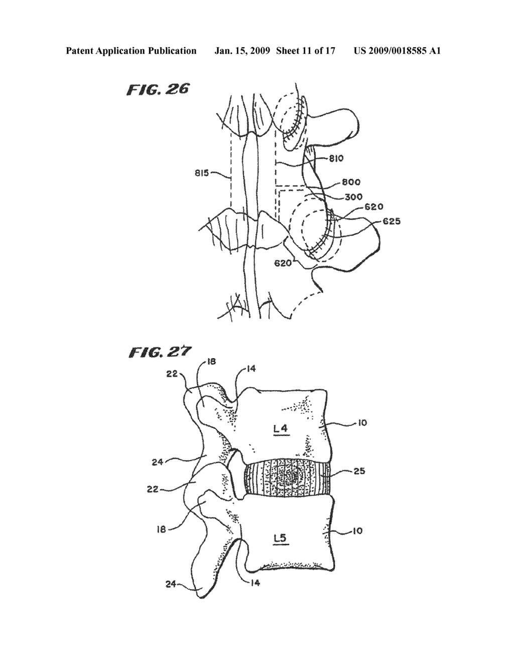 FACET ARTHROPLASTY DEVICES AND METHODS - diagram, schematic, and image 12