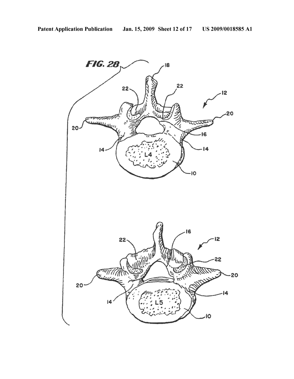 FACET ARTHROPLASTY DEVICES AND METHODS - diagram, schematic, and image 13