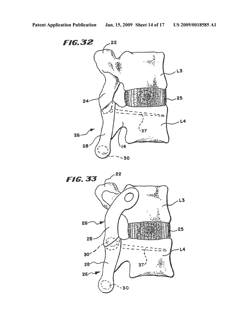 FACET ARTHROPLASTY DEVICES AND METHODS - diagram, schematic, and image 15