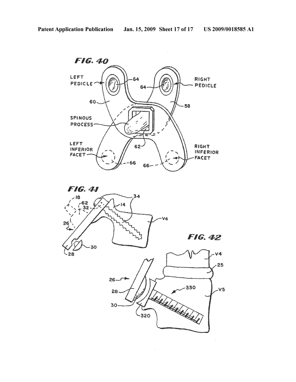 FACET ARTHROPLASTY DEVICES AND METHODS - diagram, schematic, and image 18