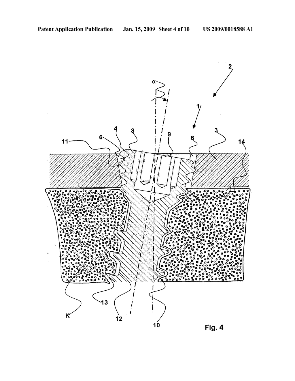 Orthopedic screw fastener system - diagram, schematic, and image 05