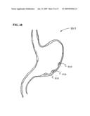 Methods And Systems for Submucosal Implantation of a Device For Diagnosis and Treatment with a Therapeutic Agent diagram and image