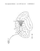 SELF-EXPANDABLE EPIDURAL CORTICAL ELECTRODE diagram and image
