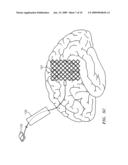 SELF-EXPANDABLE EPIDURAL CORTICAL ELECTRODE diagram and image