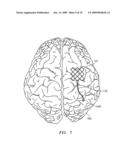 SELF-EXPANDABLE EPIDURAL CORTICAL ELECTRODE diagram and image