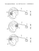 SELF-EXPANDABLE EPIDURAL CORTICAL ELECTRODE diagram and image