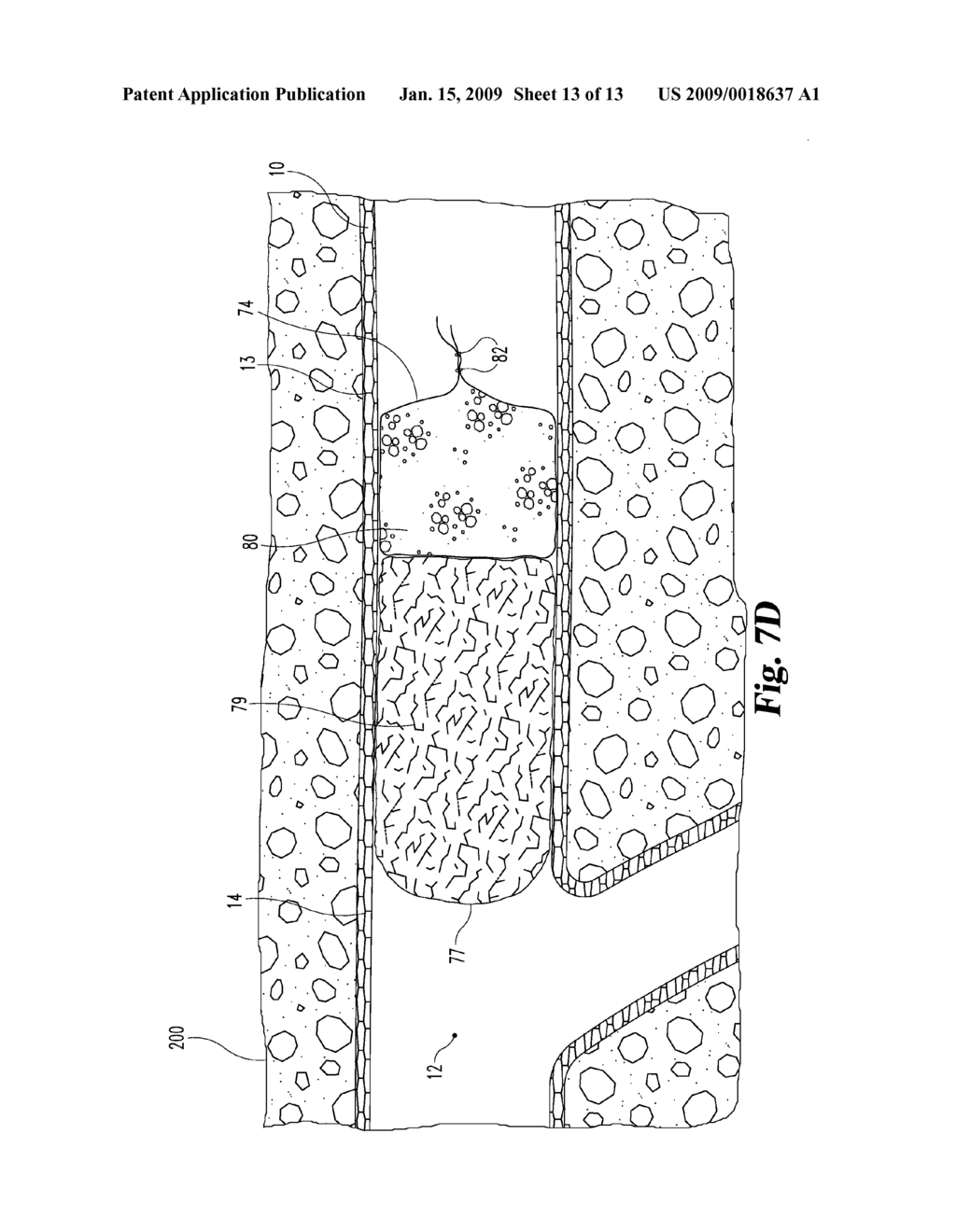 TUBULAR DEVICES HAVING REVERSIBLE COMPONENTS FOR DEPLOYMENT OF ENDOLUMINAL OCCLUDERS AND RELATED METHODS AND SYSTEMS - diagram, schematic, and image 14