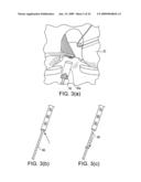 DOUBLE SOCKET ACL RECONSTRUCTION diagram and image