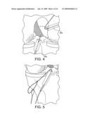 DOUBLE SOCKET ACL RECONSTRUCTION diagram and image