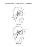 DOUBLE SOCKET ACL RECONSTRUCTION diagram and image