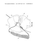 DOUBLE SOCKET ACL RECONSTRUCTION diagram and image