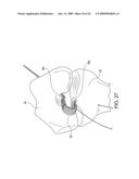 DOUBLE SOCKET ACL RECONSTRUCTION diagram and image