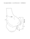 DOUBLE SOCKET ACL RECONSTRUCTION diagram and image