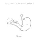 DEVICE FOR INSUFFLATING THE INTERIOR OF A GASTRIC CAVITY OF A PATIENT diagram and image