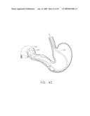DEVICE FOR INSUFFLATING THE INTERIOR OF A GASTRIC CAVITY OF A PATIENT diagram and image