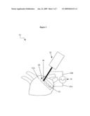 SURGICAL TREATMENT FOR ATRIAL FIBRILLATION USING RADIOFREQUENCY TECHNOLOGY diagram and image