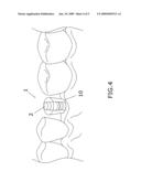 Simplified implant cap for tooth implant diagram and image