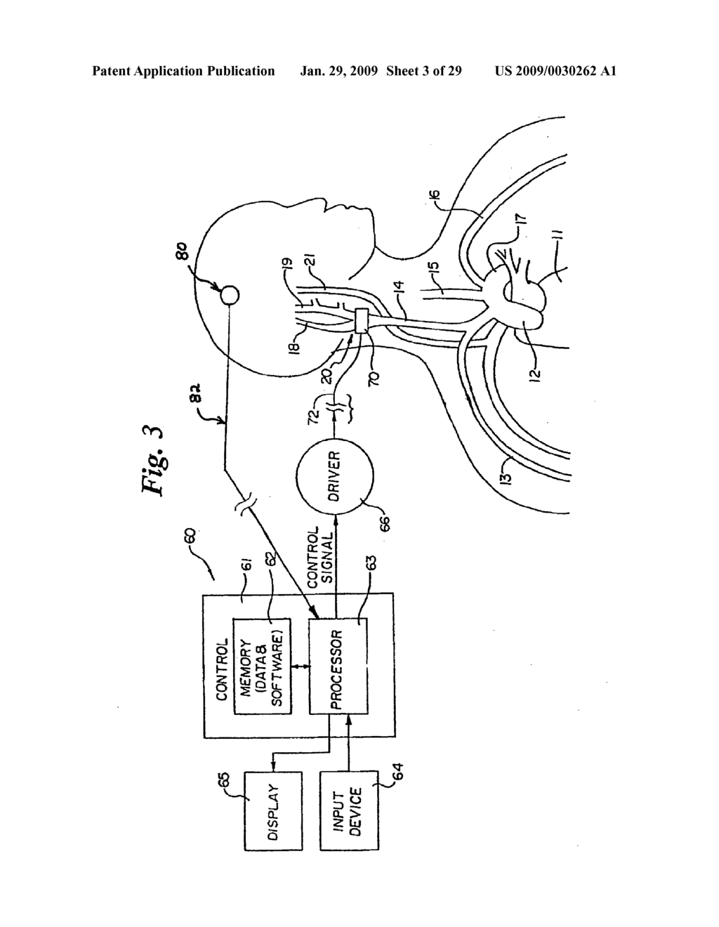 BAROREFLEX ACTIVATION FOR SEDATION AND SLEEP - diagram, schematic, and image 04