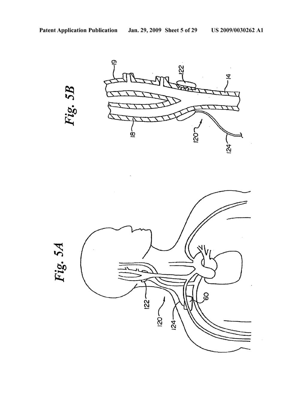 BAROREFLEX ACTIVATION FOR SEDATION AND SLEEP - diagram, schematic, and image 06