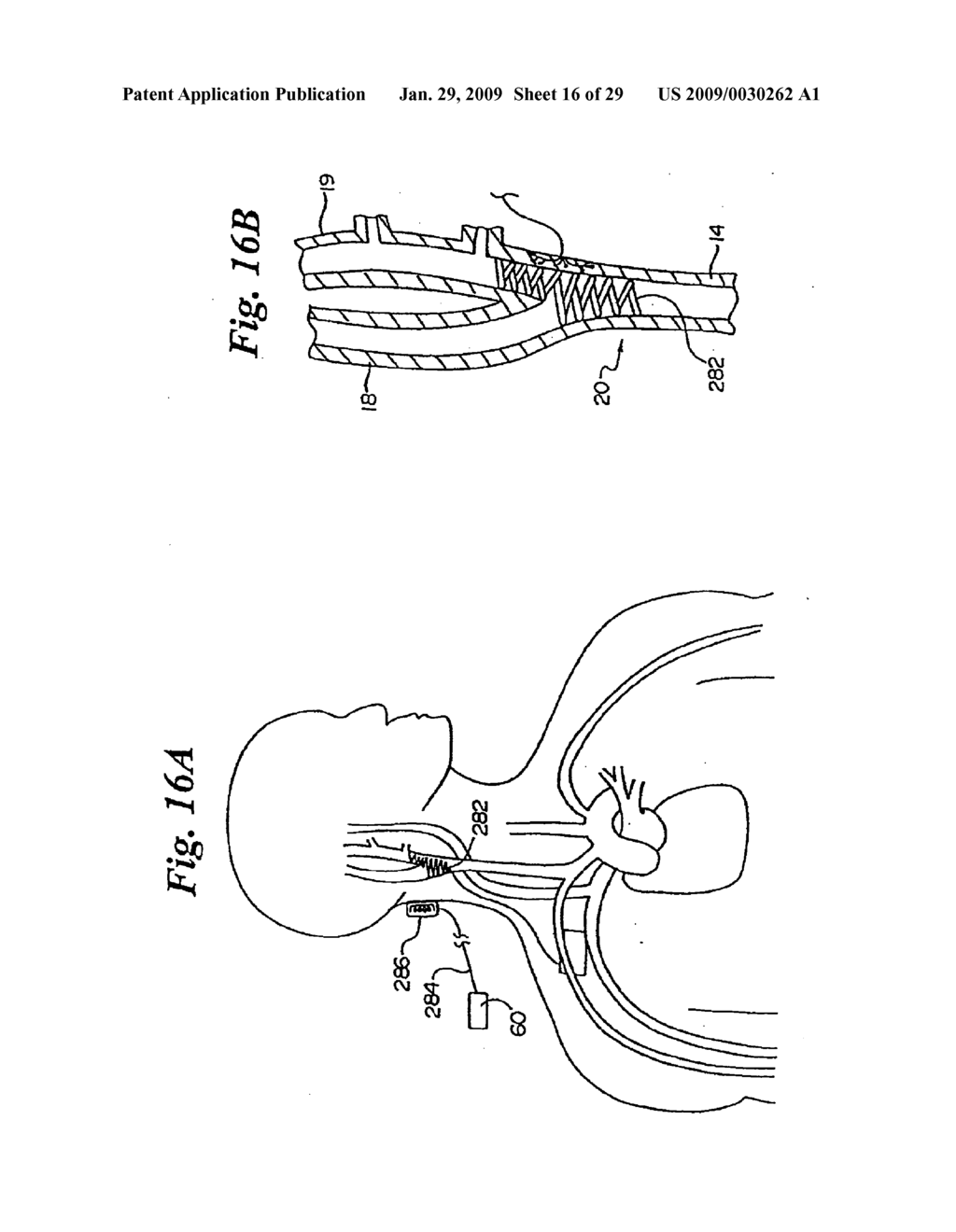 BAROREFLEX ACTIVATION FOR SEDATION AND SLEEP - diagram, schematic, and image 17