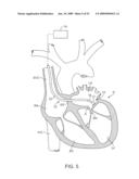 VISUAL ELECTRODE ABLATION SYSTEMS diagram and image