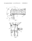 Socket For Fenestrated Tubular Prosthesis diagram and image